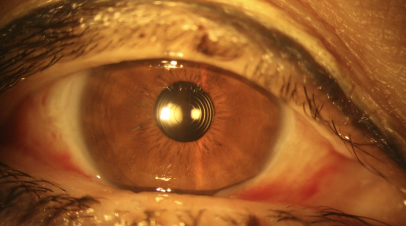 Ojo con lente intraocular